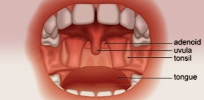 Tonsils and Adenoids (Sore throat pain) Treatment in Australia