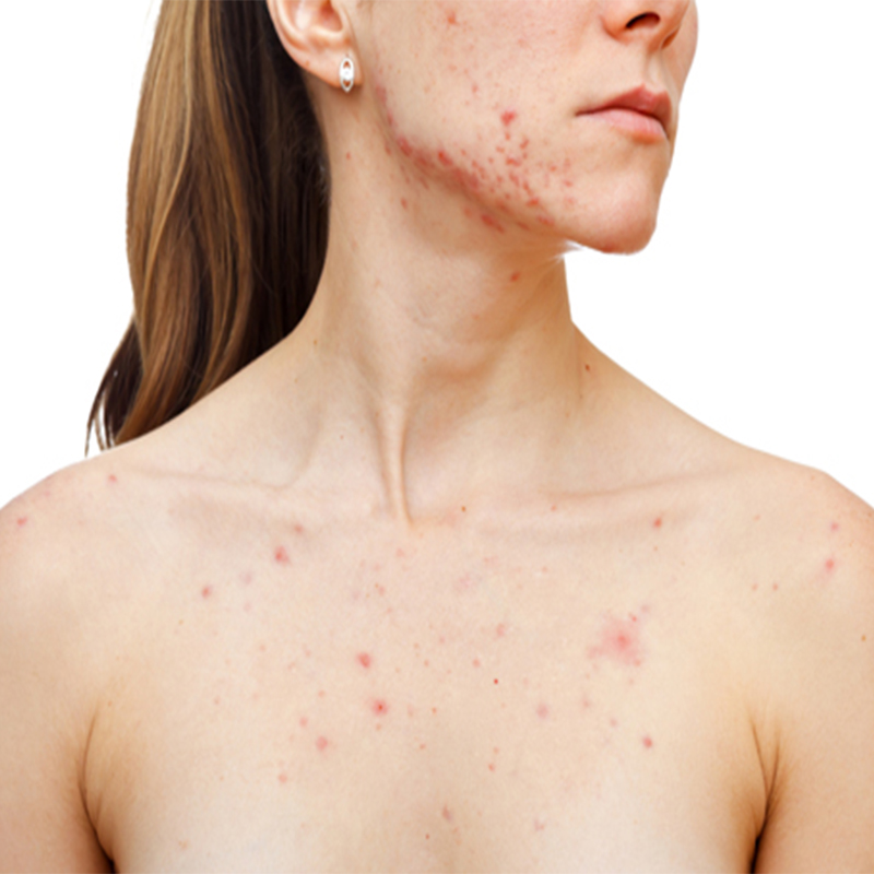 Natural Ayurvedic Hormonal Acne Scar Treatment In Sydney