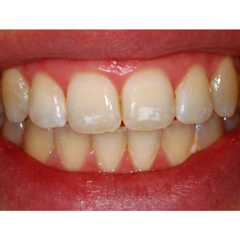 White Spots On Teeth Patches Blotches Treatment In Australia